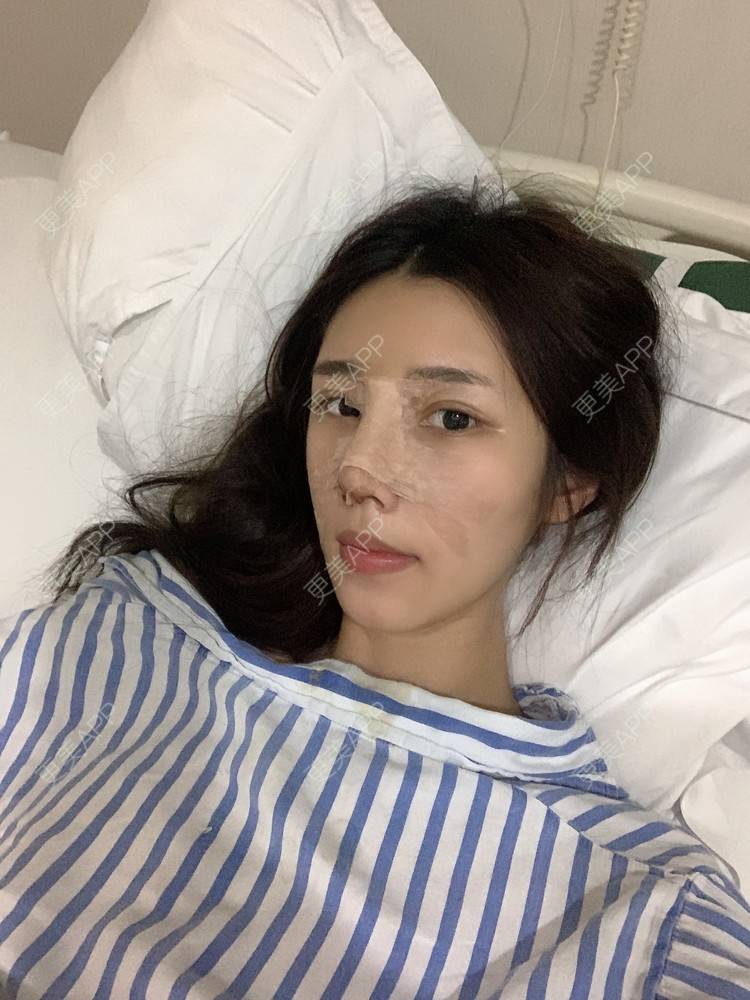 更美 - 媛媛儿~的隆鼻经验 | 隆鼻 | 肋软骨隆鼻 | 驼峰鼻矫正 | 鼻部多项 | 重庆