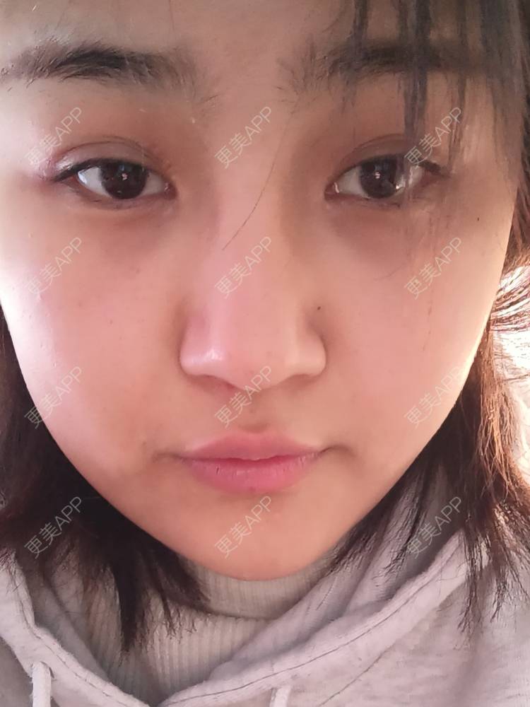 更美 - 更美用户6lAitmtq7D的自体脂肪填充泪沟经验 | 自体脂肪全面部填充 | 自体脂肪丰太阳穴 | 自体脂肪丰苹果肌 | 自体脂肪丰面颊 | 自体脂肪丰额头 | 自体脂肪填充泪沟 | 自体脂肪垫下巴 | 重庆 | 自体脂肪丰卧蚕 | 自体脂肪垫鼻基底 | 自体脂肪面部填充