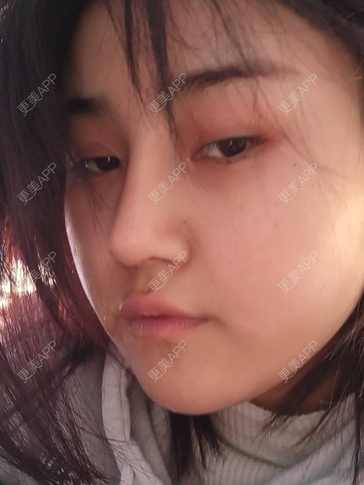 更美 - 更美用户6lAitmtq7D的自体脂肪填充泪沟经验 | 自体脂肪全面部填充 | 自体脂肪丰太阳穴 | 自体脂肪丰苹果肌 | 自体脂肪丰面颊 | 自体脂肪丰额头 | 自体脂肪填充泪沟 | 自体脂肪垫下巴 | 重庆 | 自体脂肪丰卧蚕 | 自体脂肪垫鼻基底 | 自体脂肪面部填充