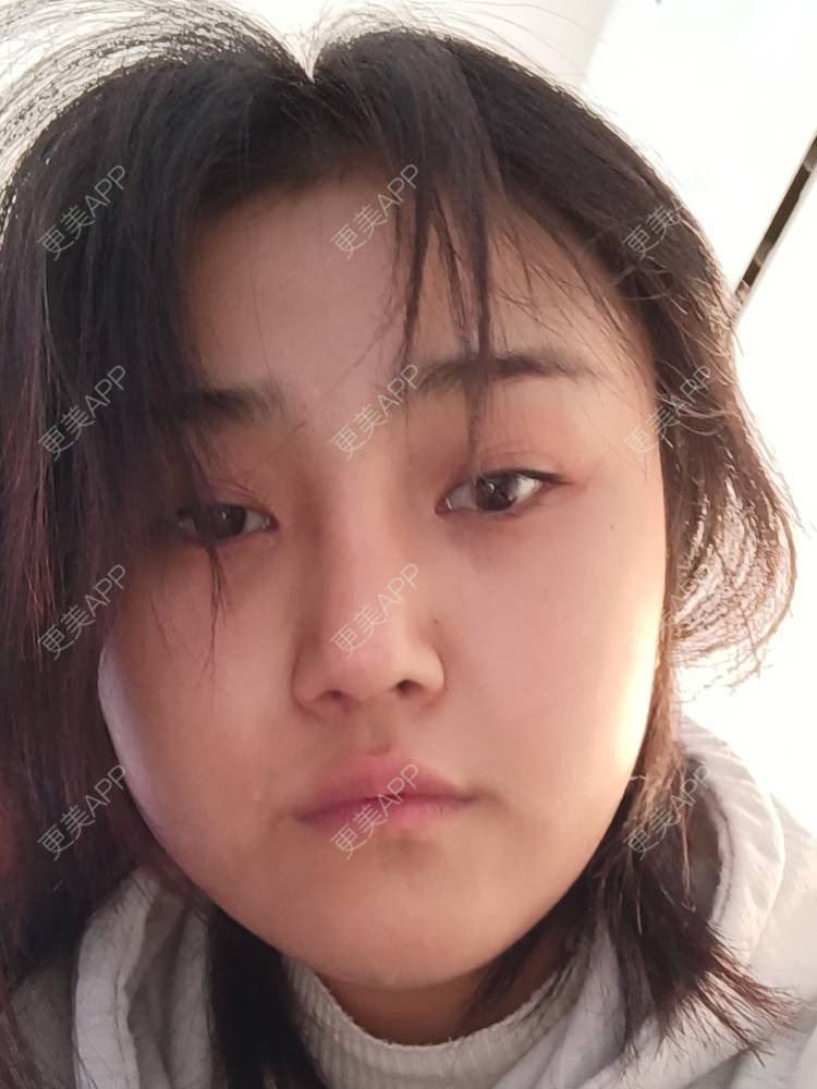 更美 - 更美用户6lAitmtq7D的自体脂肪填充泪沟经验 | 自体脂肪全面部填充 | 自体脂肪丰太阳穴 | 自体脂肪丰苹果肌 | 自体脂肪丰面颊 | 自体脂肪丰额头 | 自体脂肪填充泪沟 | 自体脂肪垫下巴 | 重庆 | 自体脂肪丰卧蚕 | 自体脂肪垫鼻基底 | 自体脂肪面部填充