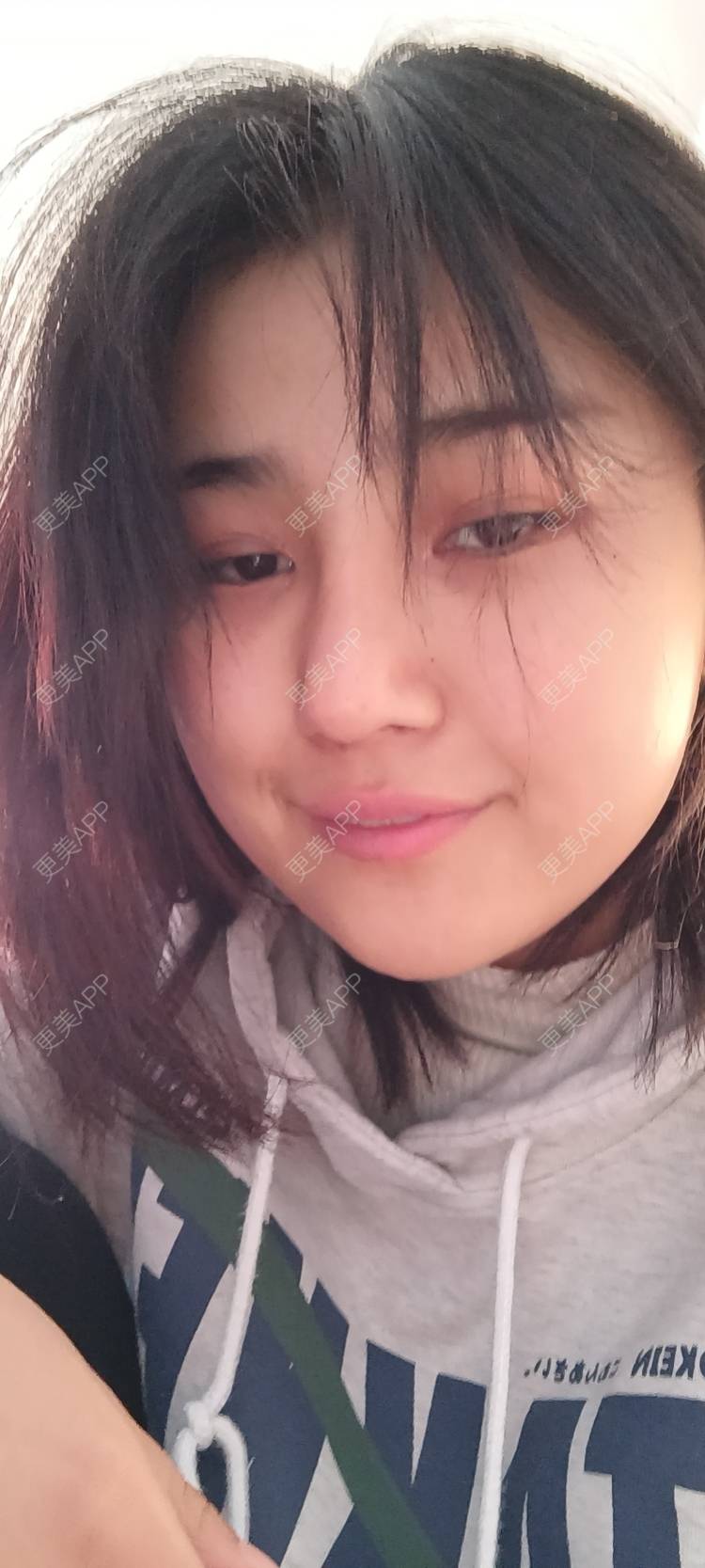更美 - 更美用户6lAitmtq7D的自体脂肪填充泪沟经验 | 自体脂肪全面部填充 | 自体脂肪丰太阳穴 | 自体脂肪丰苹果肌 | 自体脂肪丰面颊 | 自体脂肪丰额头 | 自体脂肪填充泪沟 | 自体脂肪垫下巴 | 重庆 | 自体脂肪丰卧蚕 | 自体脂肪垫鼻基底 | 自体脂肪面部填充