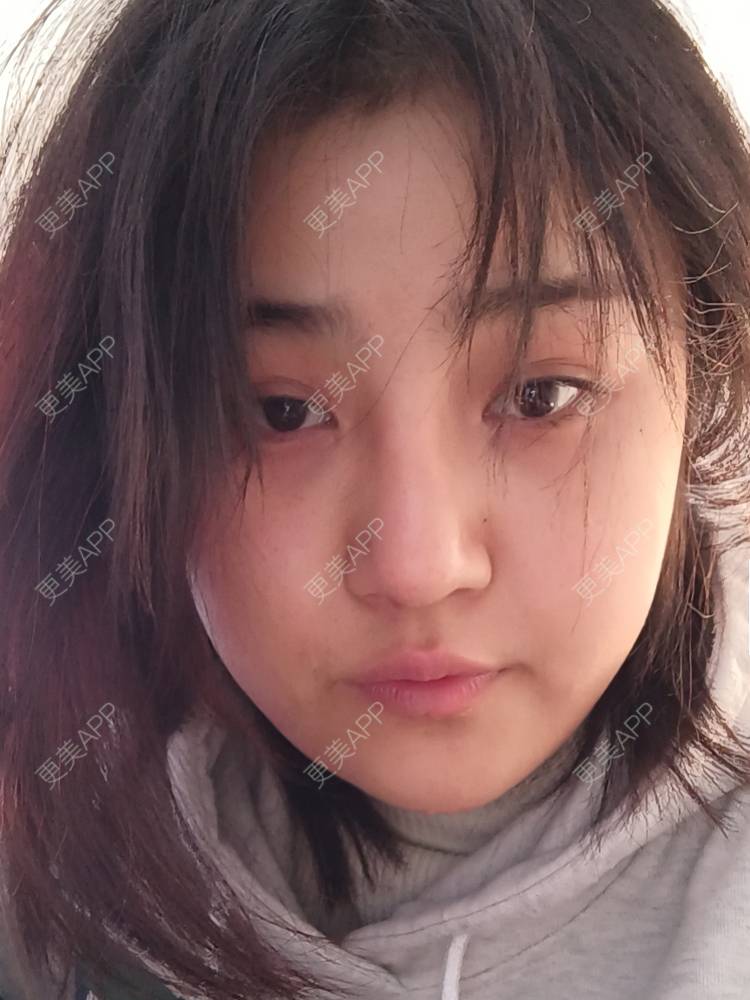 更美 - 更美用户6lAitmtq7D的自体脂肪填充泪沟经验 | 自体脂肪全面部填充 | 自体脂肪丰太阳穴 | 自体脂肪丰苹果肌 | 自体脂肪丰面颊 | 自体脂肪丰额头 | 自体脂肪填充泪沟 | 自体脂肪垫下巴 | 重庆 | 自体脂肪丰卧蚕 | 自体脂肪垫鼻基底 | 自体脂肪面部填充