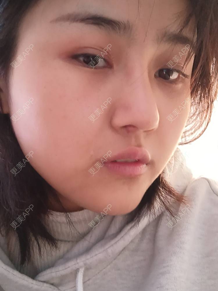更美 - 更美用户6lAitmtq7D的自体脂肪填充泪沟经验 | 自体脂肪全面部填充 | 自体脂肪丰太阳穴 | 自体脂肪丰苹果肌 | 自体脂肪丰面颊 | 自体脂肪丰额头 | 自体脂肪填充泪沟 | 自体脂肪垫下巴 | 重庆 | 自体脂肪丰卧蚕 | 自体脂肪垫鼻基底 | 自体脂肪面部填充
