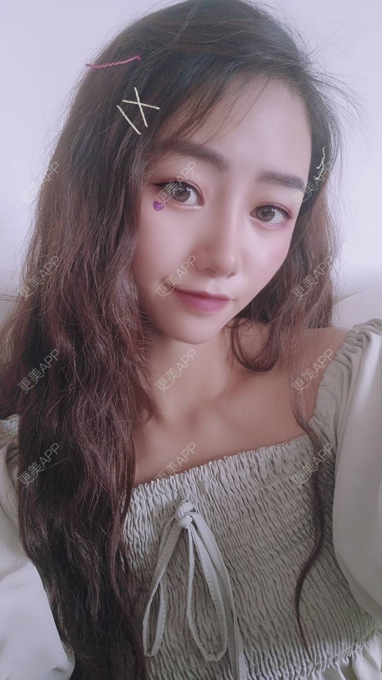 更美 - 眷恋着你的温柔傥的自体脂肪全面部填充经验 | 自体脂肪全面部填充 | 南京