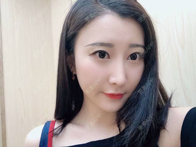 更美 - 徐利利的鼻部修复经验 | 鼻部修复 | 广州 | 双眼皮修复