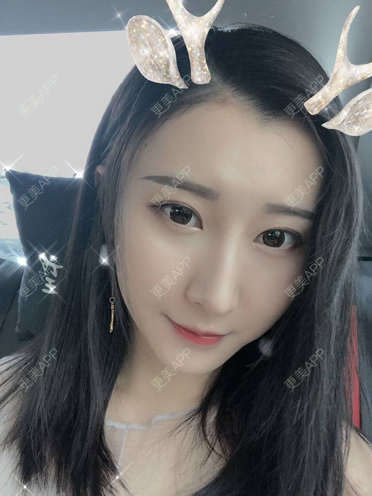 更美 - 徐利利的鼻部修复经验 | 鼻部修复 | 广州 | 双眼皮修复