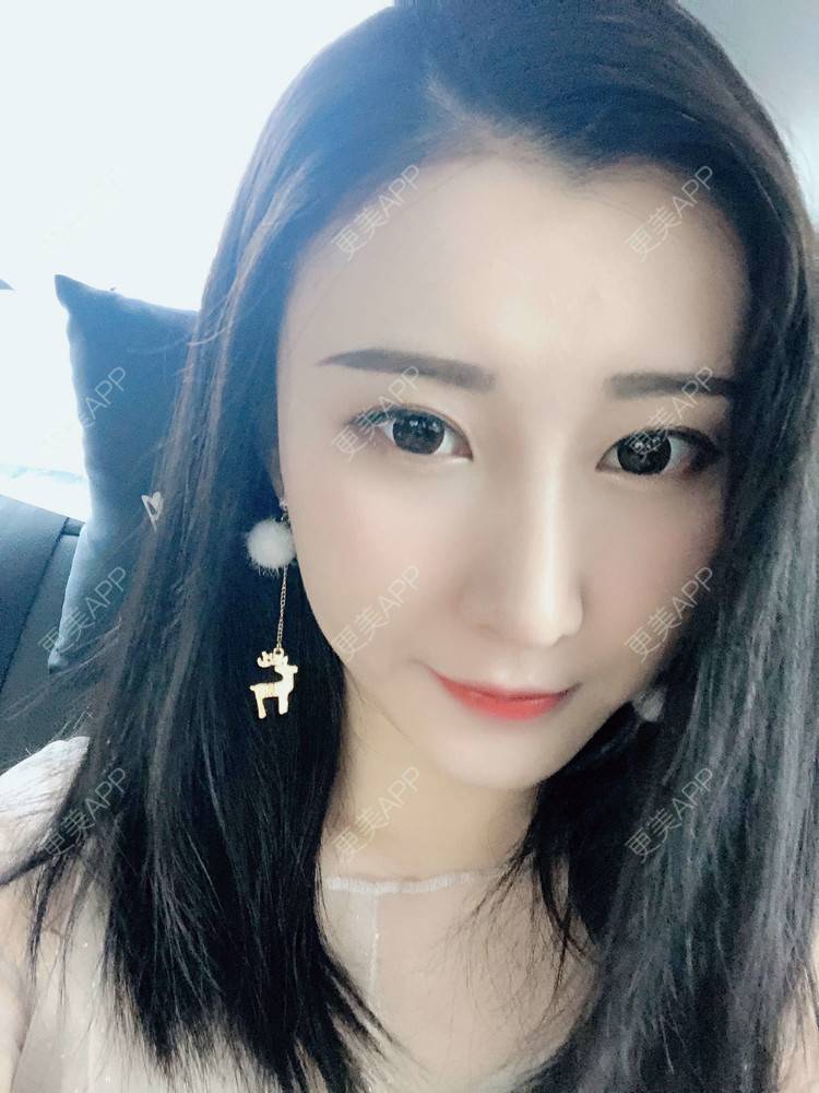 更美 - 徐利利的鼻部修复经验 | 鼻部修复 | 广州 | 双眼皮修复