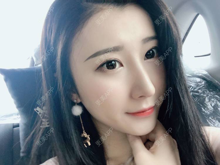 更美 - 徐利利的鼻部修复经验 | 鼻部修复 | 广州 | 双眼皮修复