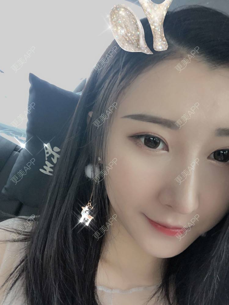 更美 - 徐利利的鼻部修复经验 | 鼻部修复 | 广州 | 双眼皮修复