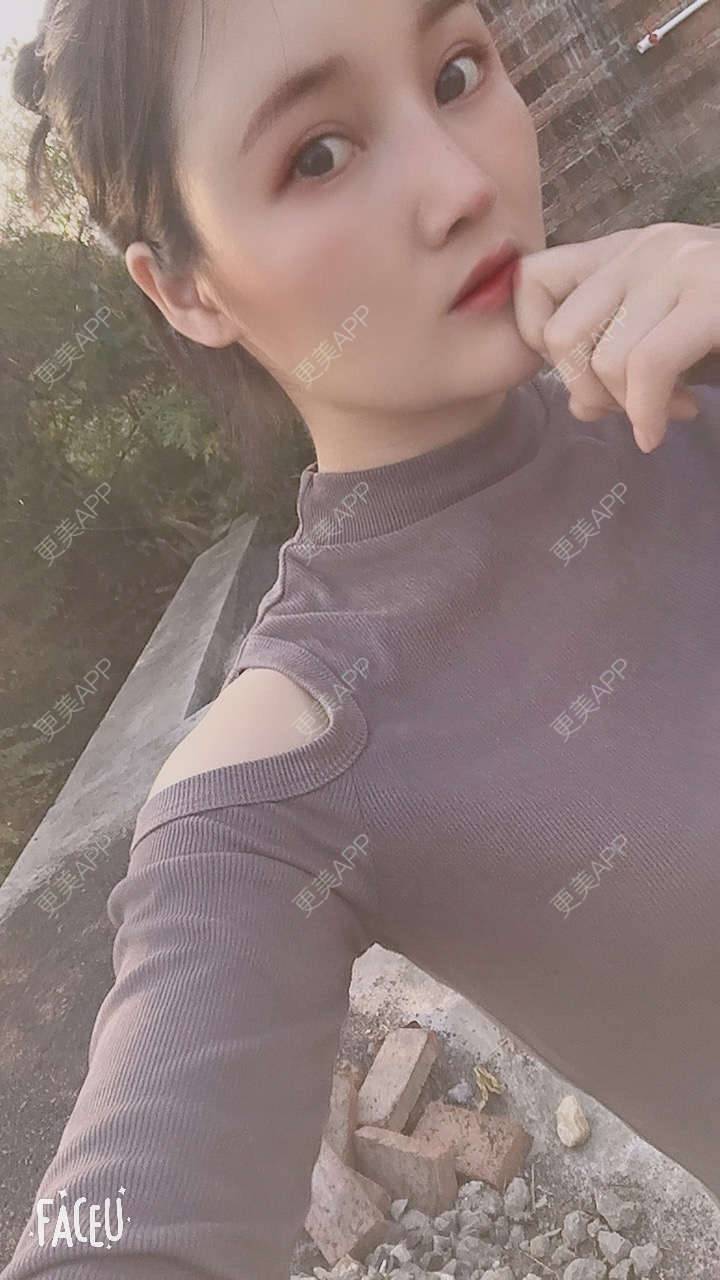 更美 - 青柠味的夏天的隆鼻经验 | 广州 | 隆鼻
