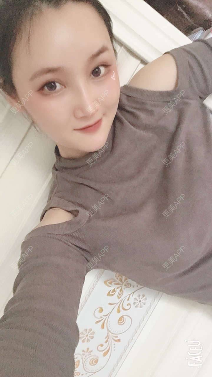 更美 - 青柠味的夏天的隆鼻经验 | 广州 | 隆鼻