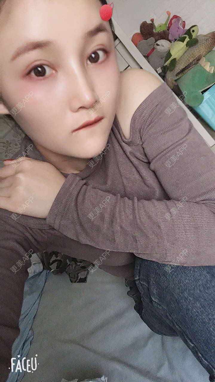 更美 - 青柠味的夏天的隆鼻经验 | 广州 | 隆鼻