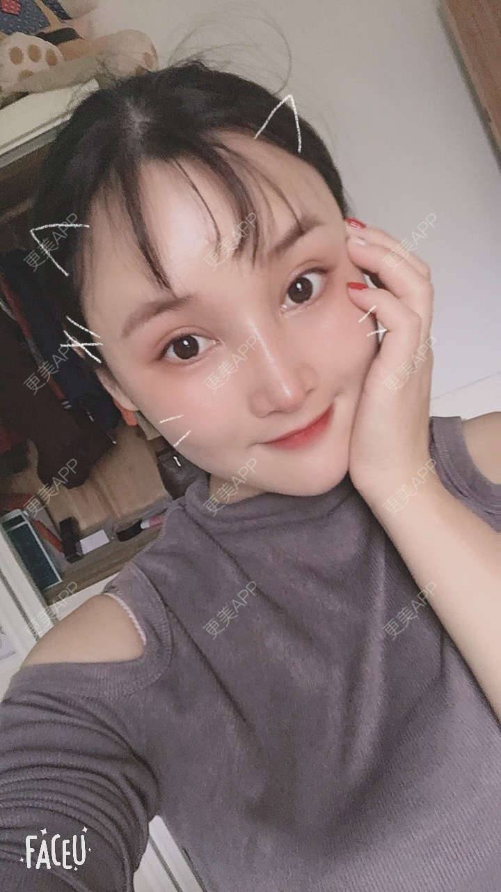 更美 - 青柠味的夏天的隆鼻经验 | 广州 | 隆鼻
