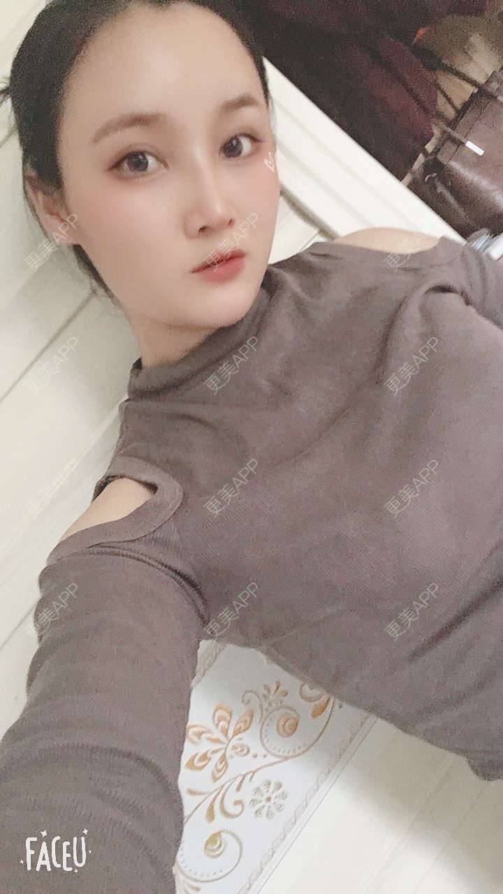 更美 - 青柠味的夏天的隆鼻经验 | 广州 | 隆鼻