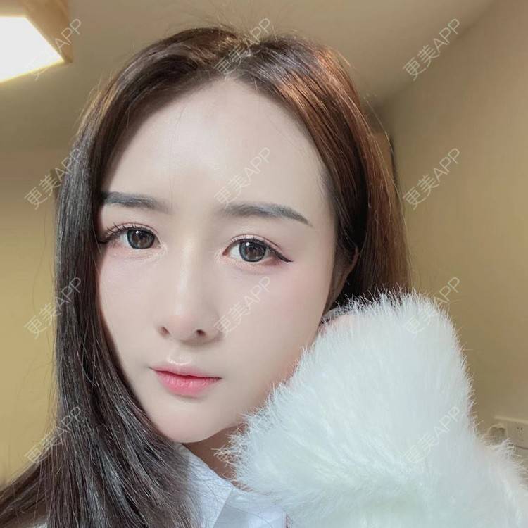 更美 - 晚点恋爱i百的自体脂肪全面部填充经验 | 自体脂肪全面部填充 | 重庆