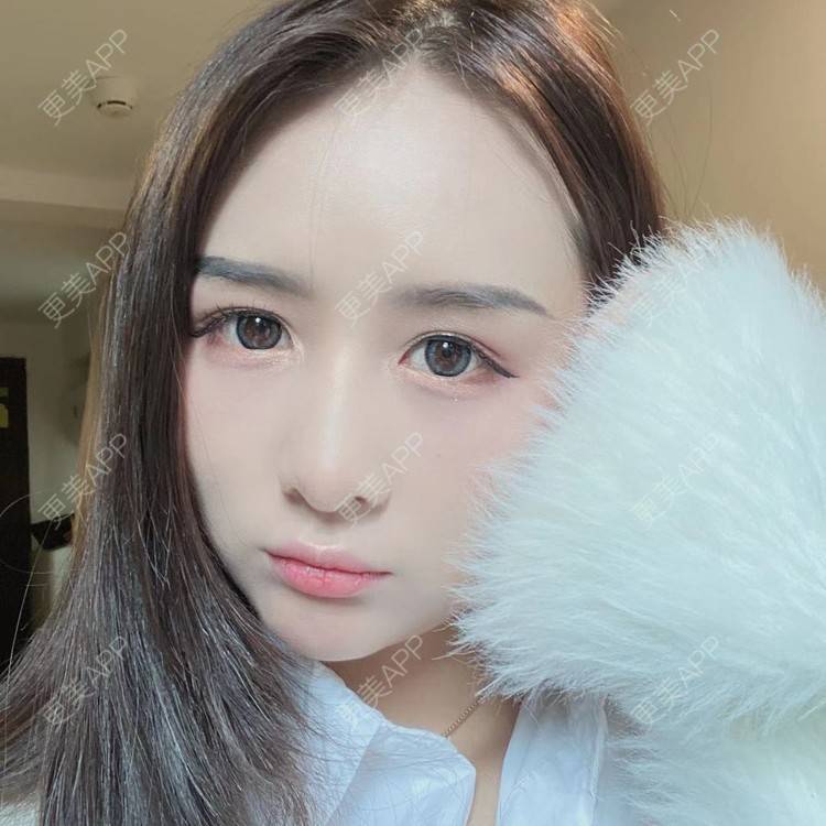 更美 - 晚点恋爱i百的自体脂肪全面部填充经验 | 自体脂肪全面部填充 | 重庆