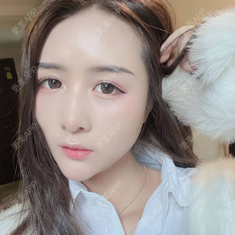 更美 - 晚点恋爱i百的自体脂肪全面部填充经验 | 自体脂肪全面部填充 | 重庆