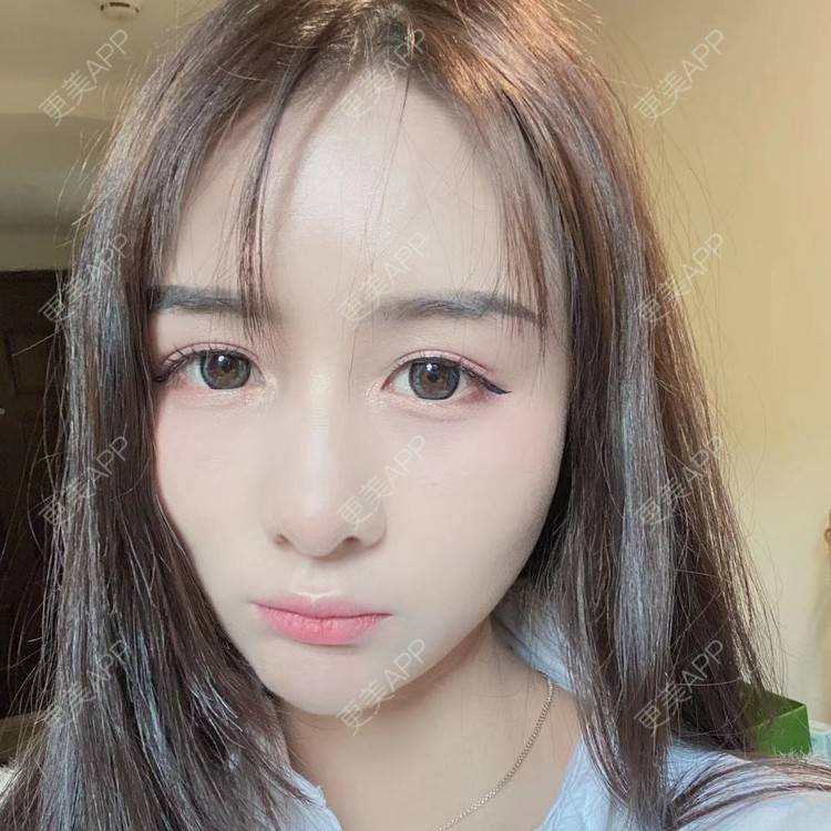 更美 - 晚点恋爱i百的自体脂肪全面部填充经验 | 自体脂肪全面部填充 | 重庆