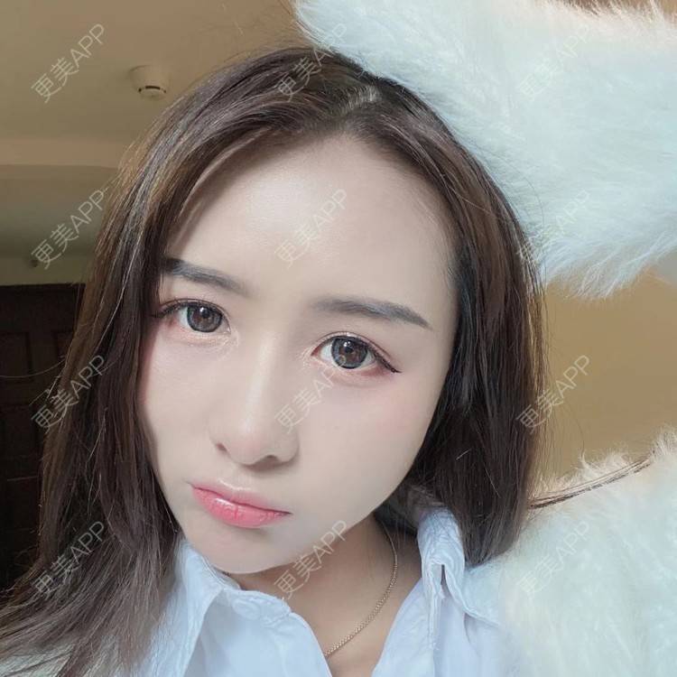 更美 - 晚点恋爱i百的自体脂肪全面部填充经验 | 自体脂肪全面部填充 | 重庆