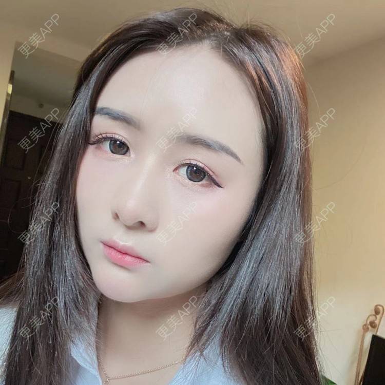 更美 - 晚点恋爱i百的自体脂肪全面部填充经验 | 自体脂肪全面部填充 | 重庆