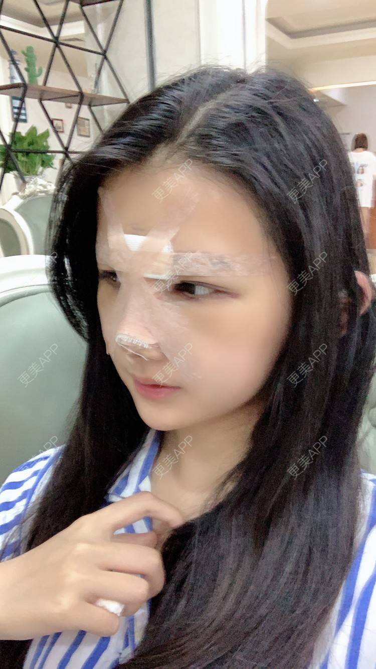 更美 - 敏敏-的鼻小柱延长经验 | 隆鼻 | 朝天鼻矫正 | 鼻孔矫正 | 鼻部多项 | 鼻小柱延长 | 重庆