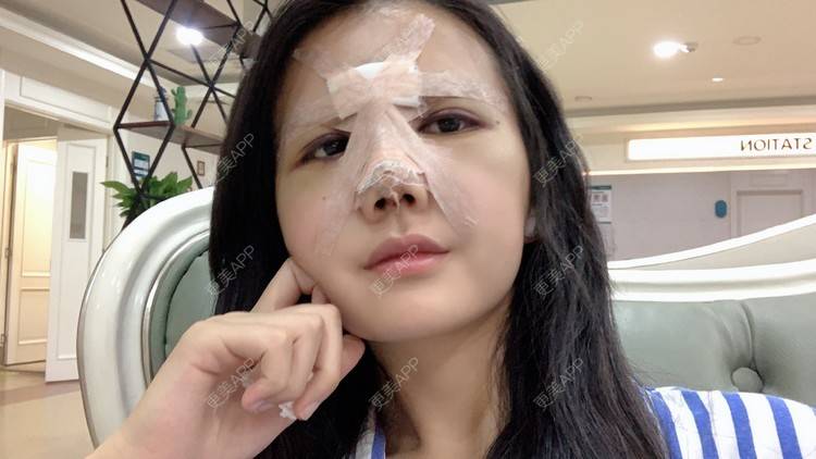 更美 - 敏敏-的鼻小柱延长经验 | 隆鼻 | 朝天鼻矫正 | 鼻孔矫正 | 鼻部多项 | 鼻小柱延长 | 重庆