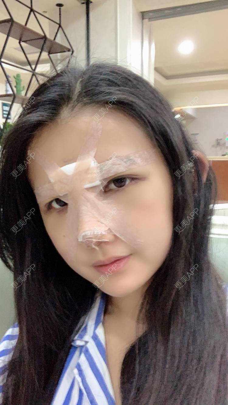 更美 - 敏敏-的鼻小柱延长经验 | 隆鼻 | 朝天鼻矫正 | 鼻孔矫正 | 鼻部多项 | 鼻小柱延长 | 重庆