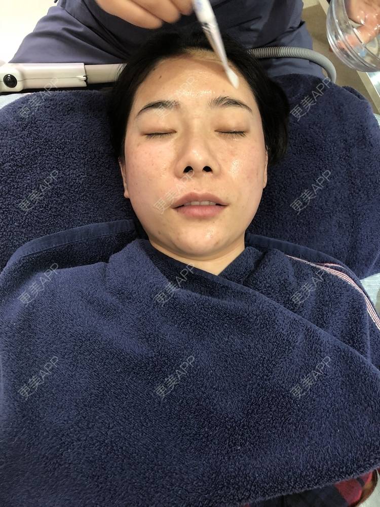 更美 - 更美用户SlOdw7zLNS的淡斑套餐经验 | 淡斑套餐 | 重庆