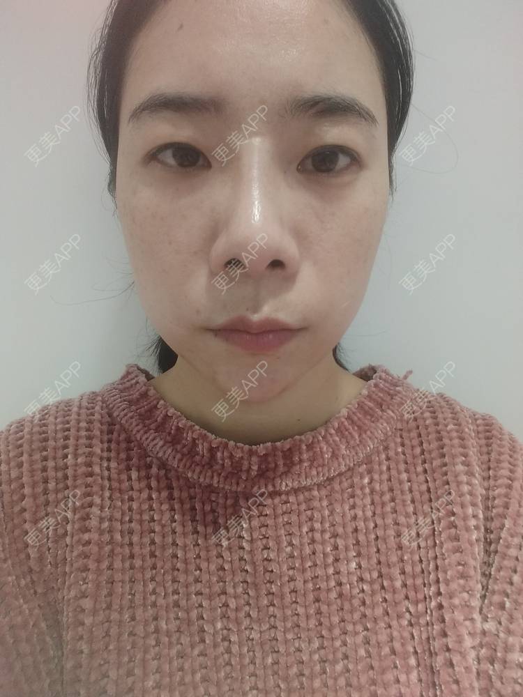 更美 - 更美用户SlOdw7zLNS的淡斑套餐经验 | 淡斑套餐 | 重庆