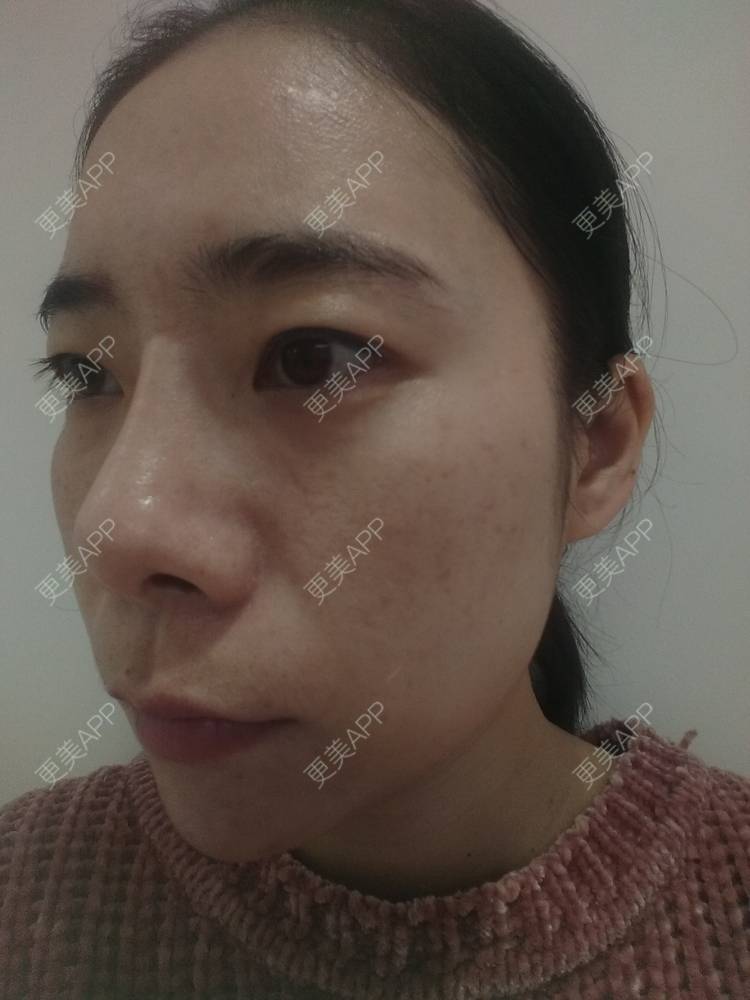 更美 - 更美用户SlOdw7zLNS的淡斑套餐经验 | 淡斑套餐 | 重庆