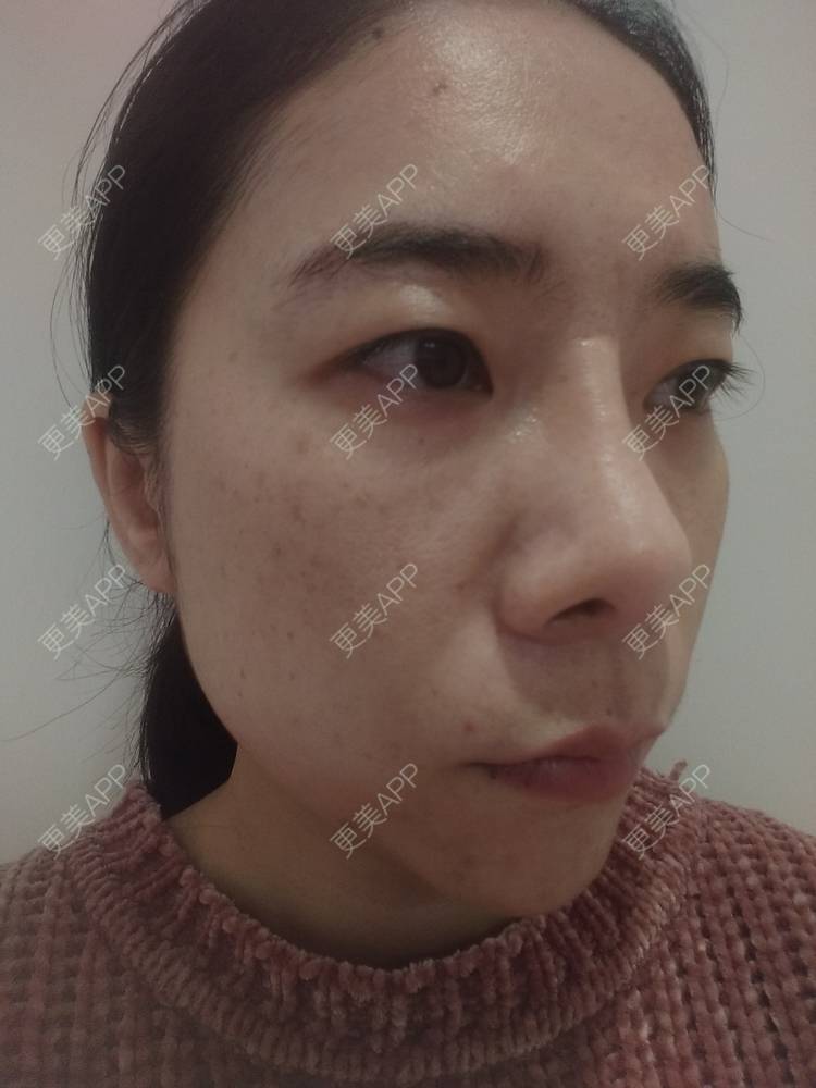 更美 - 更美用户SlOdw7zLNS的淡斑套餐经验 | 淡斑套餐 | 重庆