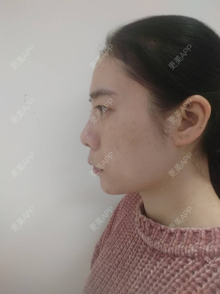 更美 - 更美用户SlOdw7zLNS的淡斑套餐经验 | 淡斑套餐 | 重庆