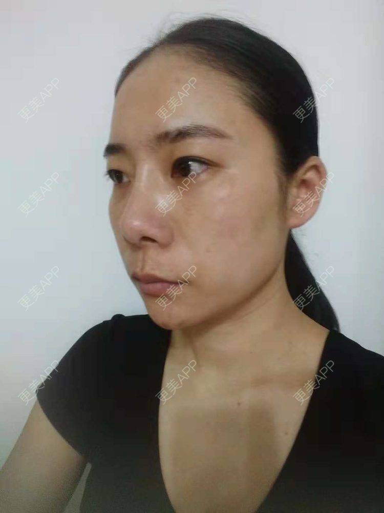 更美 - 更美用户SlOdw7zLNS的淡斑套餐经验 | 淡斑套餐 | 重庆