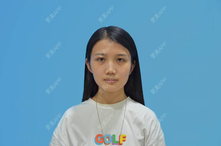 更美 - 敏敏-的鼻小柱延长经验 | 隆鼻 | 耳软骨隆鼻 | 鼻翼缩小 | 朝天鼻矫正 | 鼻部多项 | 鼻孔矫正 | 鼻小柱延长 | 重庆