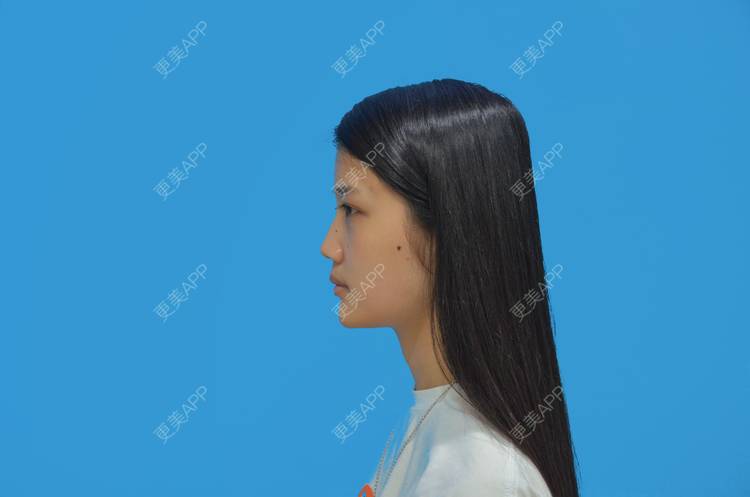 更美 - 敏敏-的鼻小柱延长经验 | 隆鼻 | 耳软骨隆鼻 | 鼻翼缩小 | 朝天鼻矫正 | 鼻部多项 | 鼻孔矫正 | 鼻小柱延长 | 重庆