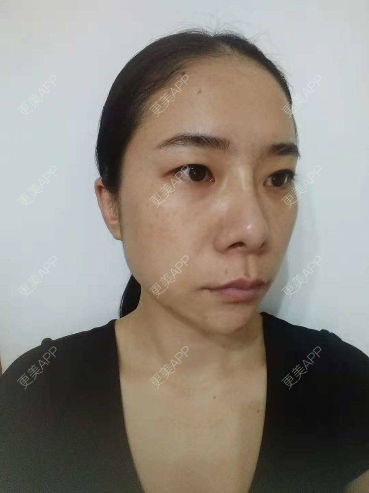 更美 - 更美用户SlOdw7zLNS的淡斑套餐经验 | 淡斑套餐 | 重庆