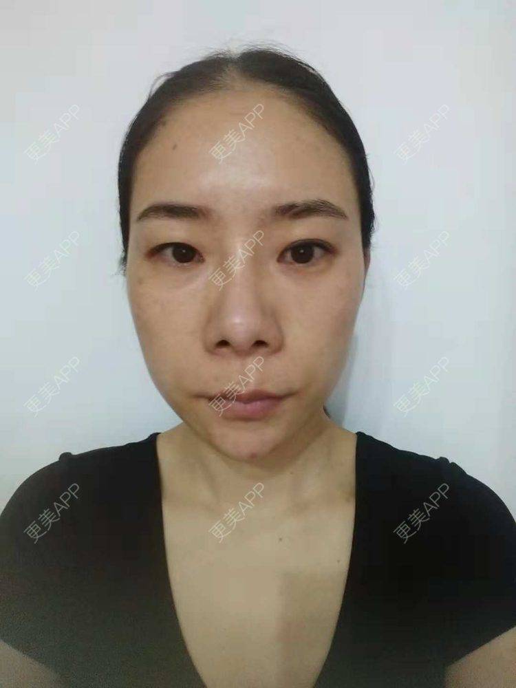 更美 - 更美用户SlOdw7zLNS的淡斑套餐经验 | 淡斑套餐 | 重庆