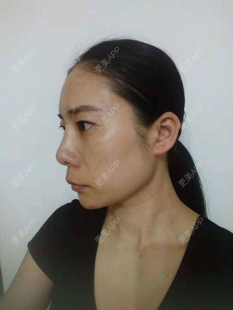 更美 - 更美用户SlOdw7zLNS的淡斑套餐经验 | 淡斑套餐 | 重庆