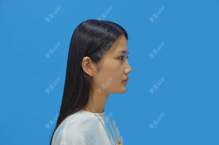 更美 - 敏敏-的鼻小柱延长经验 | 隆鼻 | 耳软骨隆鼻 | 鼻翼缩小 | 朝天鼻矫正 | 鼻部多项 | 鼻孔矫正 | 鼻小柱延长 | 重庆