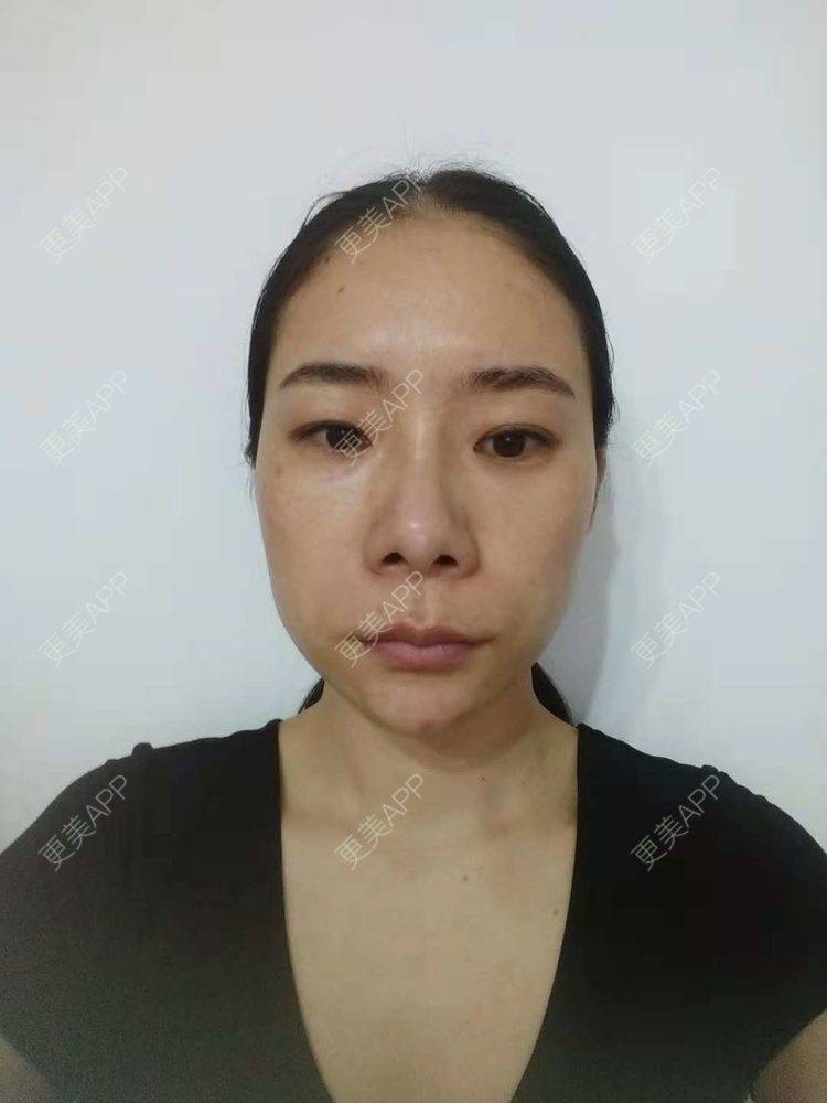 更美 - 更美用户SlOdw7zLNS的淡斑套餐经验 | 淡斑套餐 | 重庆