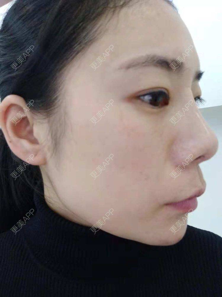 更美 - 更美用户SlOdw7zLNS的淡斑套餐经验 | 淡斑套餐 | 重庆
