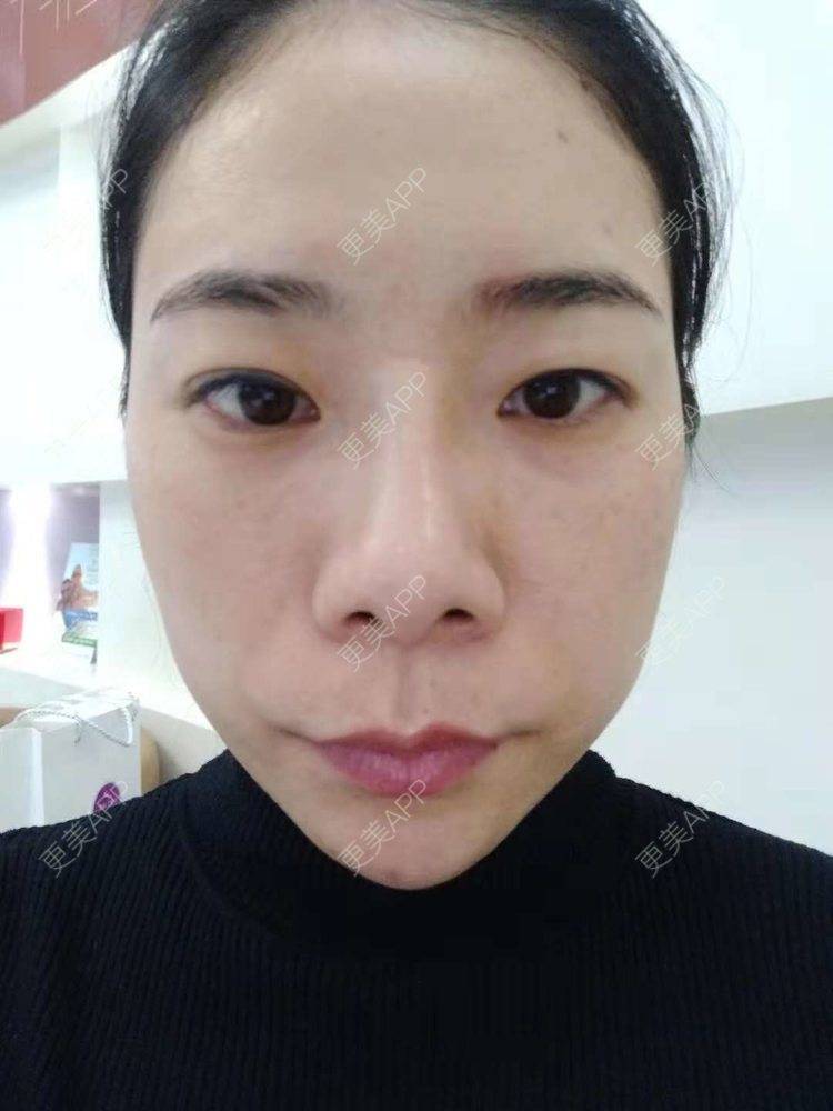 更美 - 更美用户SlOdw7zLNS的淡斑套餐经验 | 淡斑套餐 | 重庆