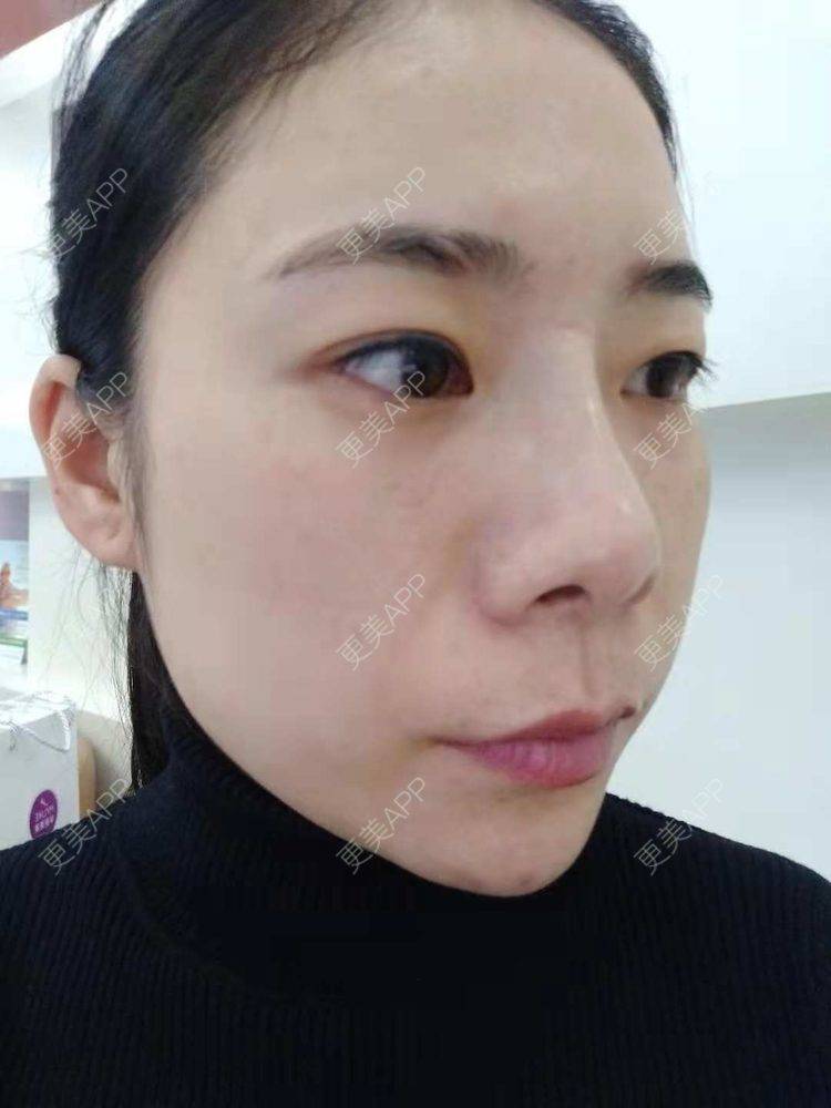 更美 - 更美用户SlOdw7zLNS的淡斑套餐经验 | 淡斑套餐 | 重庆