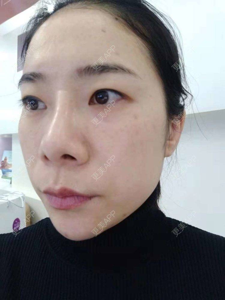 更美 - 更美用户SlOdw7zLNS的淡斑套餐经验 | 淡斑套餐 | 重庆