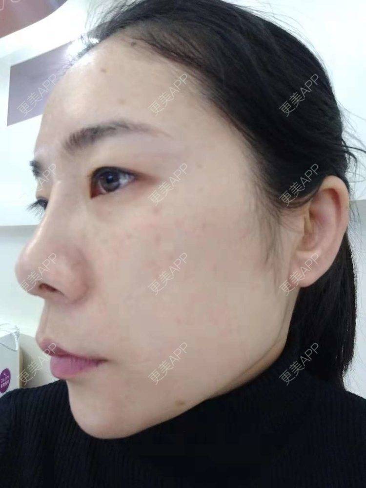 更美 - 更美用户SlOdw7zLNS的淡斑套餐经验 | 淡斑套餐 | 重庆