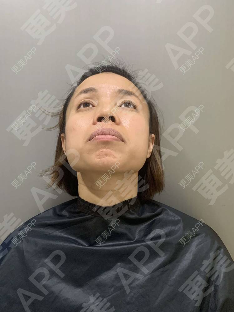 更美 - 更美用户tEad6dlAZq的凸嘴矫正经验 | 凸嘴矫正 | 武汉