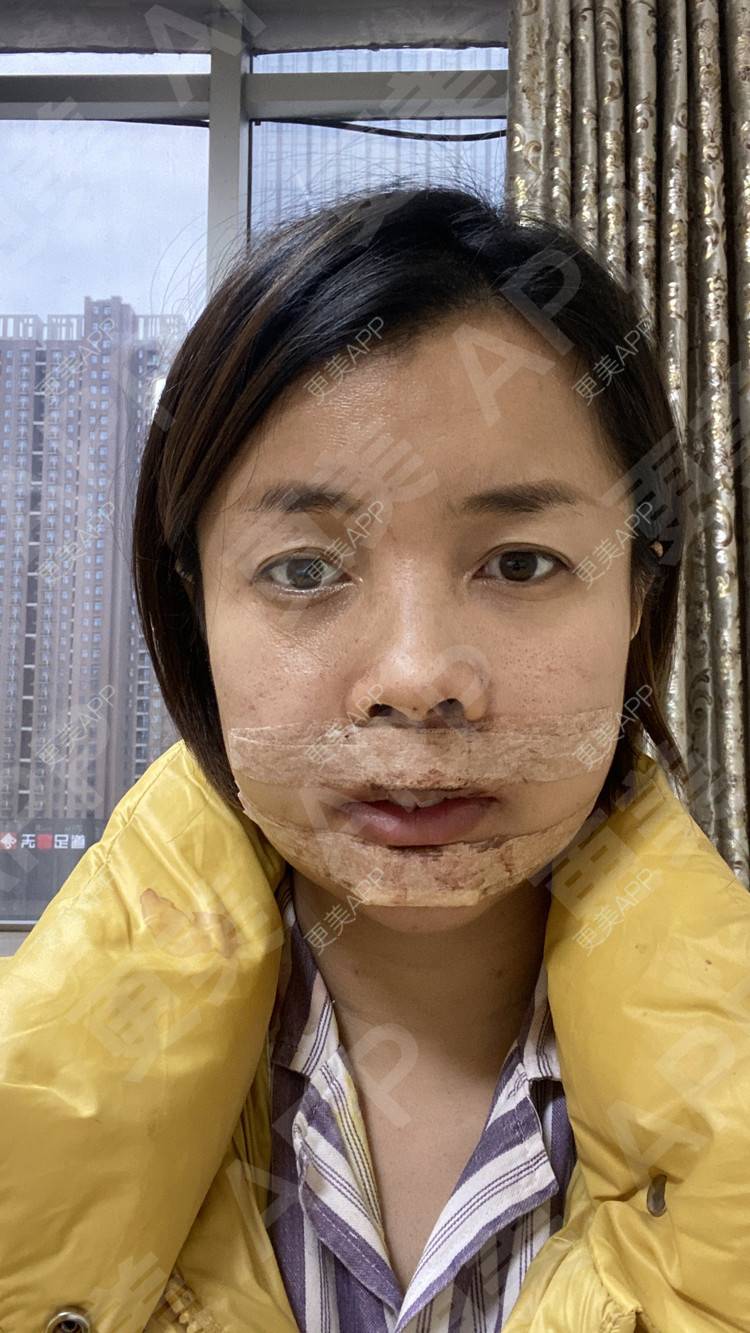 更美 - 更美用户tEad6dlAZq的凸嘴矫正经验 | 凸嘴矫正 | 武汉