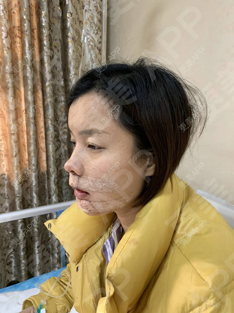 更美 - 更美用户tEad6dlAZq的凸嘴矫正经验 | 凸嘴矫正 | 武汉