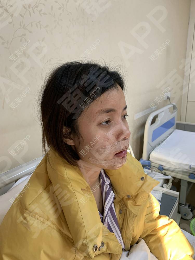 更美 - 更美用户tEad6dlAZq的凸嘴矫正经验 | 凸嘴矫正 | 武汉