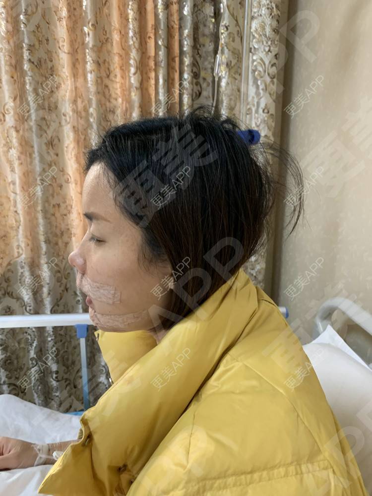更美 - 更美用户tEad6dlAZq的凸嘴矫正经验 | 凸嘴矫正 | 武汉